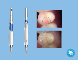 MouthCAM Pro Intraoral Camera | MouthCAM | Dentulu Pro
